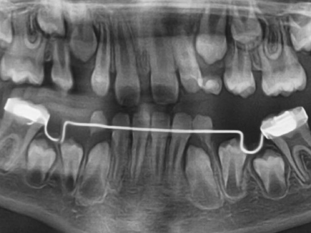 Lingvalni i transpalatinalni lukovi