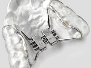 Hyrax - aparat za ubrzano širenje nepca