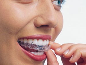 Ortodontska terapija alignerima (udlagama) - nevidljivi aparatić