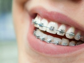 6 loših navika koje uništavaju vaše zube